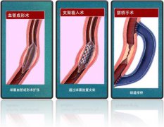 怎樣治療冠心病？