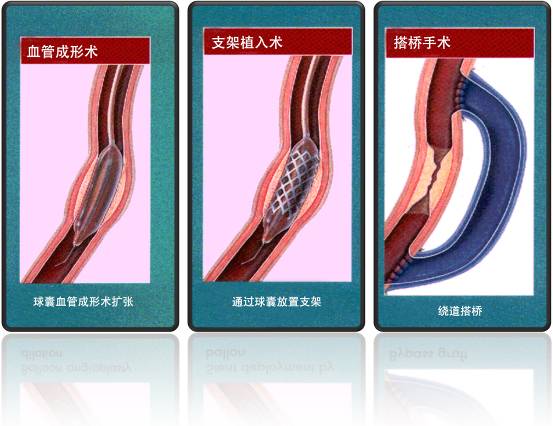 怎樣治療冠心?。?圖1)